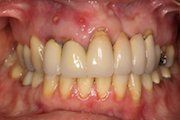 Dental Rehabilitation for Adults with a history of Cleft Lip / Palate — Hamilton, NJ — Joseph Randazzo DDS