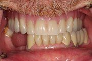 Before Partial Dentures — Hamilton, NJ — Joseph Randazzo DDS