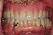 After Partial Dentures — Hamilton, NJ — Joseph Randazzo DDS