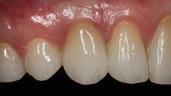 After Single Tooth Implant — Hamilton, NJ — Joseph Randazzo DDS