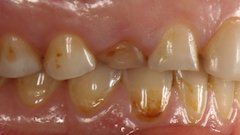 Before Single Tooth Implant — Hamilton, NJ — Joseph Randazzo DDS