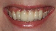 After Dental Rehabilitations following Dentofacial Trauma — Hamilton, NJ — Joseph Randazzo DDS