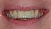 Before Dental Rehabilitations following Dentofacial Trauma — Hamilton, NJ — Joseph Randazzo DDS