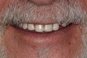 Case 1 Before Implant Retained Dentures — Hamilton, NJ — Joseph Randazzo DDS