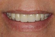 Case 2 After Dental Implant — Hamilton, NJ — Joseph Randazzo DDS