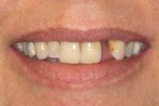 Case 2 Before Dental Implant — Hamilton, NJ — Joseph Randazzo DDS