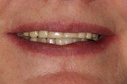 Case 3 Before Dental Implant — Hamilton, NJ — Joseph Randazzo DDS