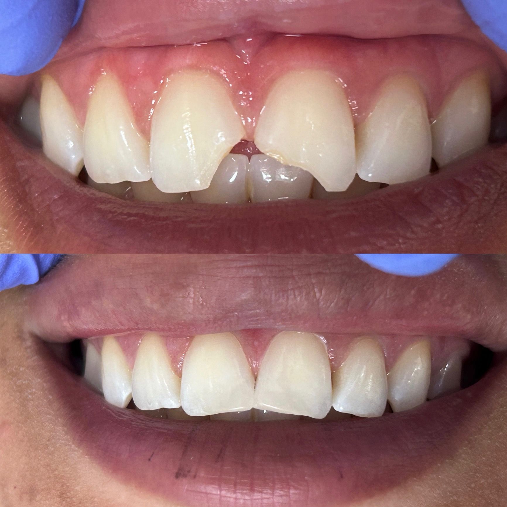 A before and after picture of a person 's teeth  | Clinton, MS | Dental Care of Clinton