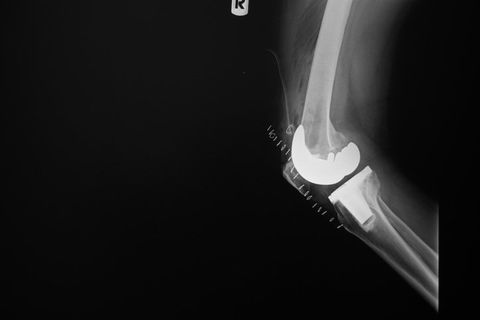 X-Ray Image of Knee Joint — Marietta, GA — Atlanta Osteoarthritis Center LLC