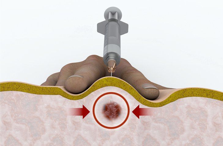 Trigger Point Injection  — Marietta, GA — Atlanta Osteoarthritis Center LLC