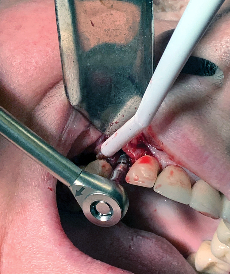 Reverse torque being used to remove failed implant.