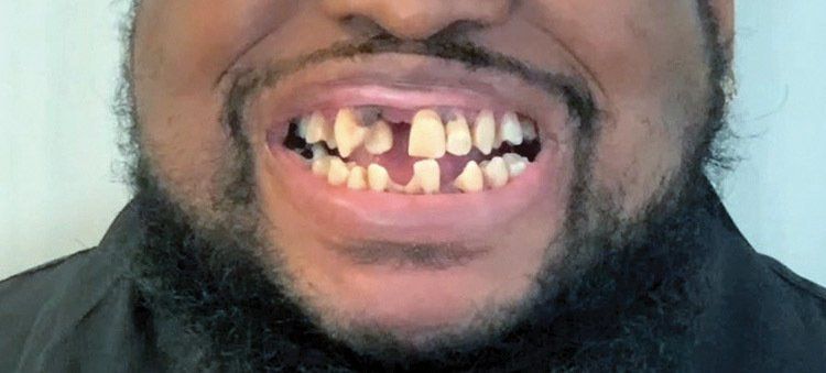 Patient smile before extraction of all teeth.