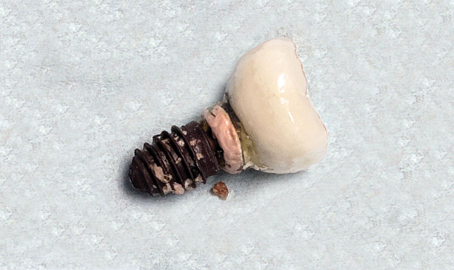 Image of a failed dental implant caused by cement irritation