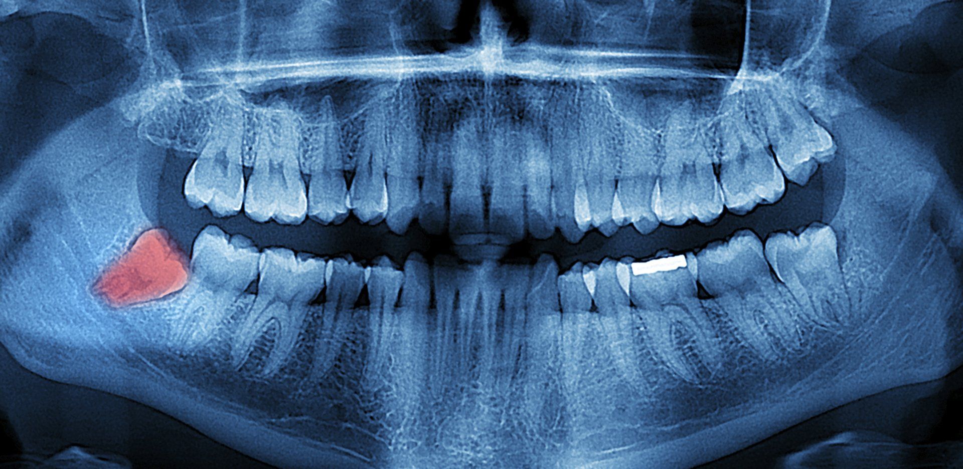 Panoramic X-ray of  impacted wisdom tooth.