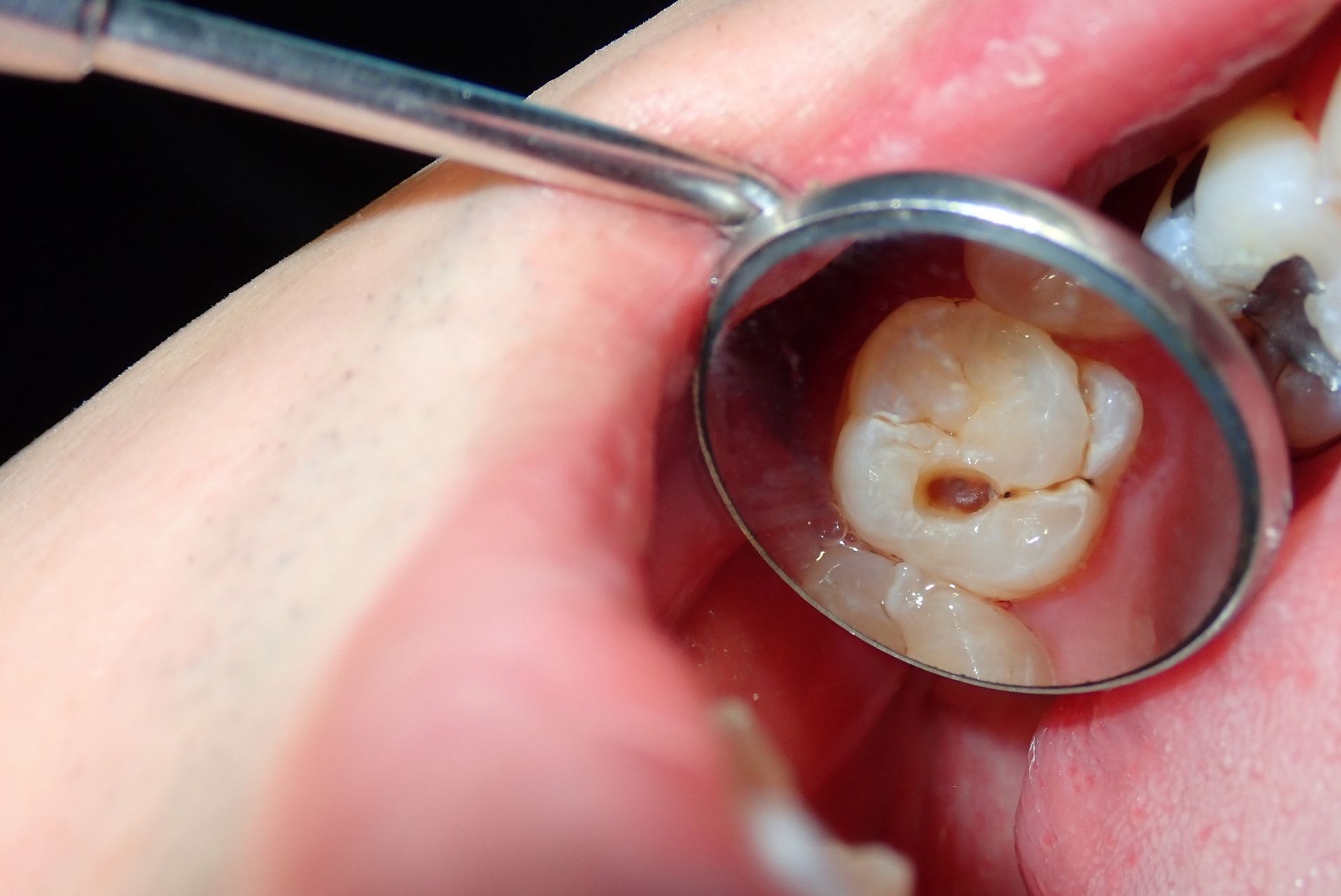 A dentist is examining a tooth with a mirror.