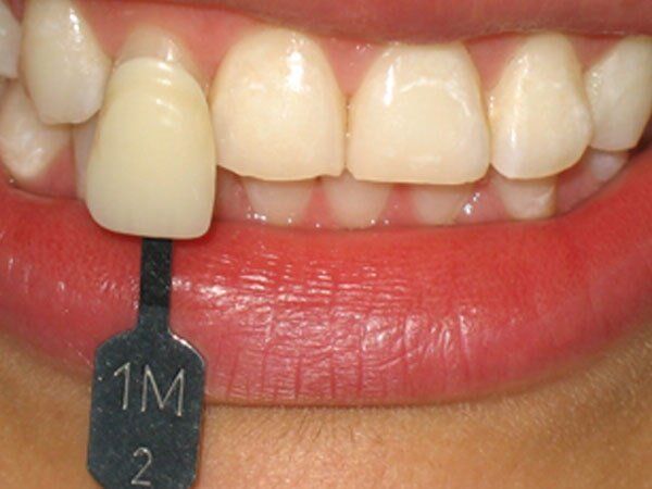 SONRISANAR - Implantes