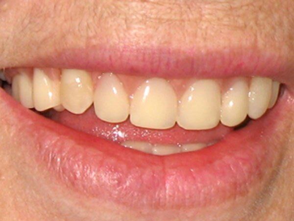 SONRISANAR - Protesis