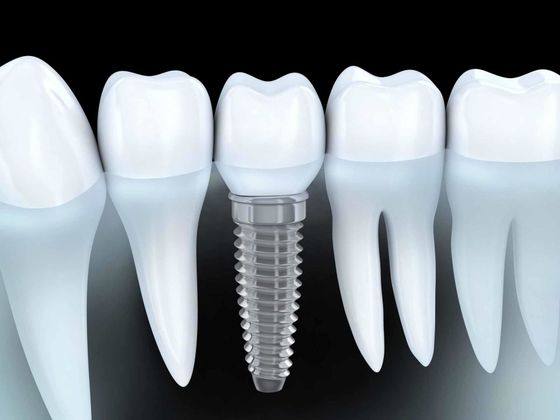 Dentist — Dental Implant in Allentown, PA