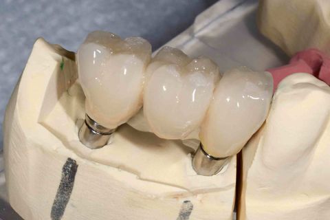 Implants — Dental Implant in Allentown, PA