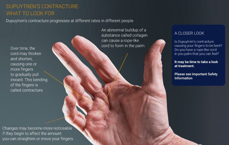 XiaflexTM is the first and only FDA-approved, nonsurgical treatment for adults with Dupuytren’s contracture when a cord can be felt