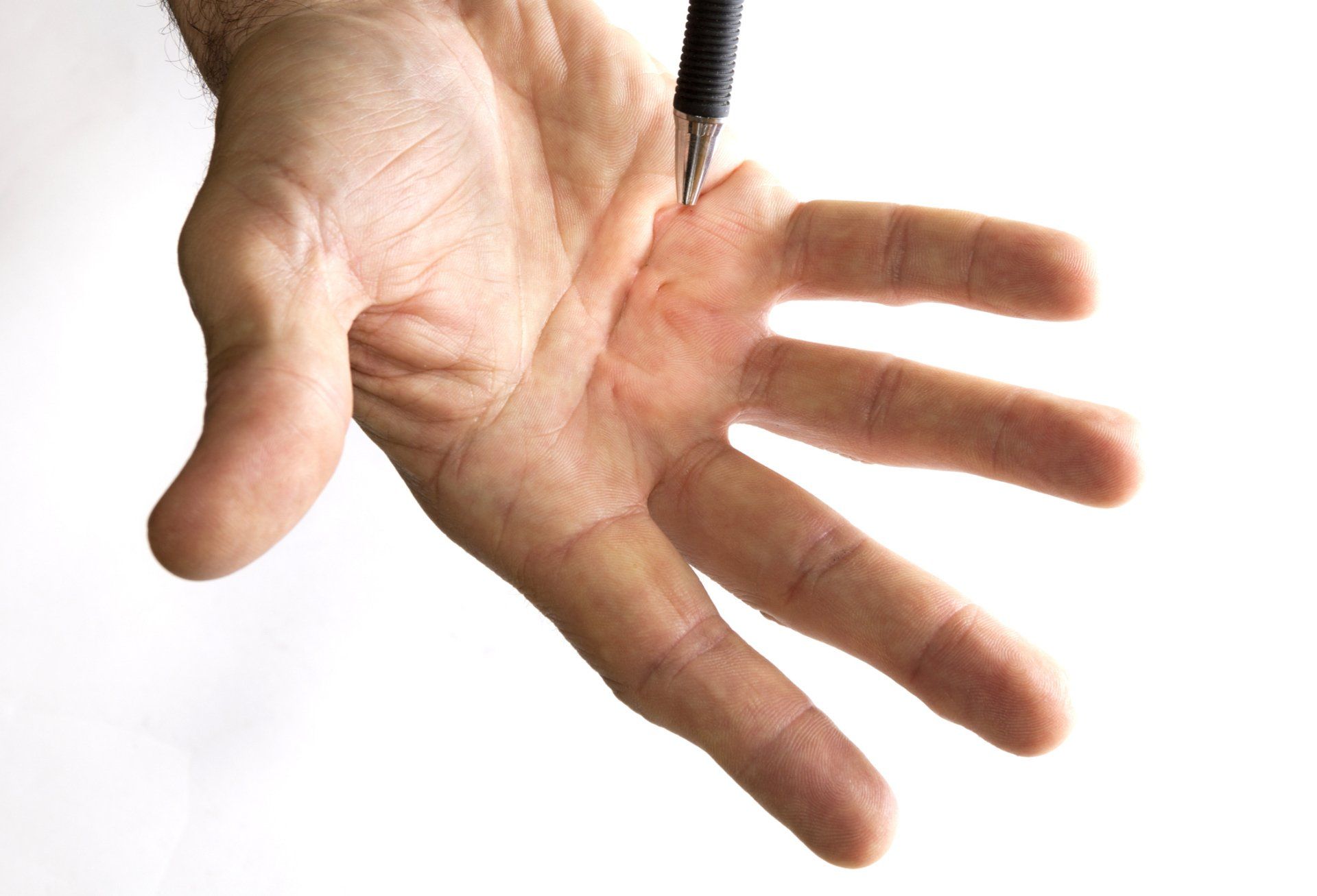 Trigger finger - Symptoms and causes - Mayo Clinic