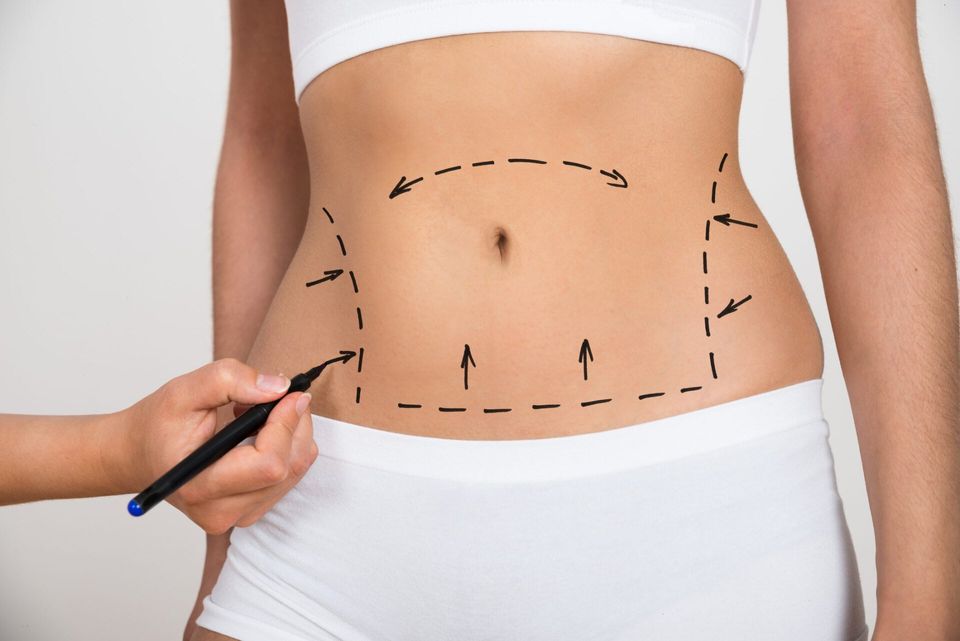 Liposuction Process — Saginaw, MI — Barry, Ronald C MD