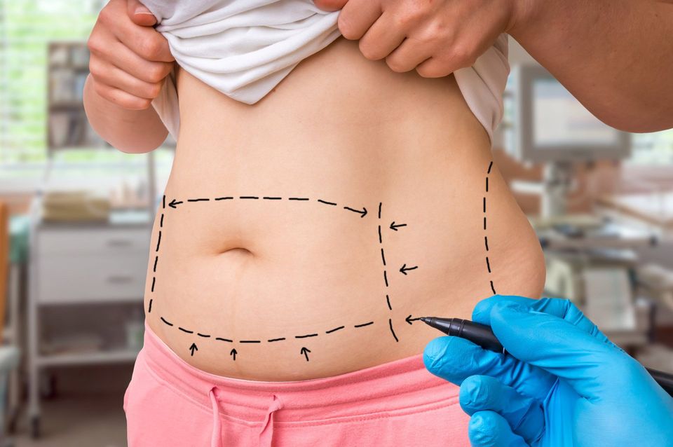 Lines With Marker On Patient Belly — Saginaw, MI — Barry, Ronald C MD