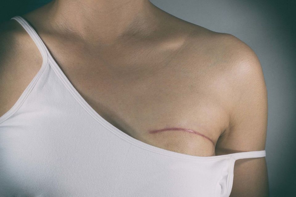 Breast Cancer Surgery Scars  — Saginaw, MI — Barry, Ronald C MD