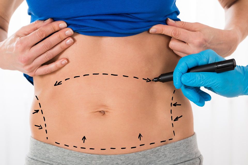 What Can a Tummy Tuck Address? What Can It Not?