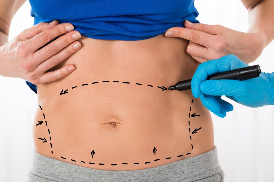 Tummy Tuck Surgery, Abdominoplasty