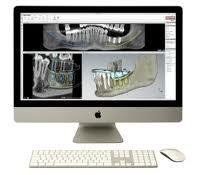 Riproduzione 3D dei denti