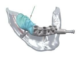 Riproduzione 3D per impianto dentale