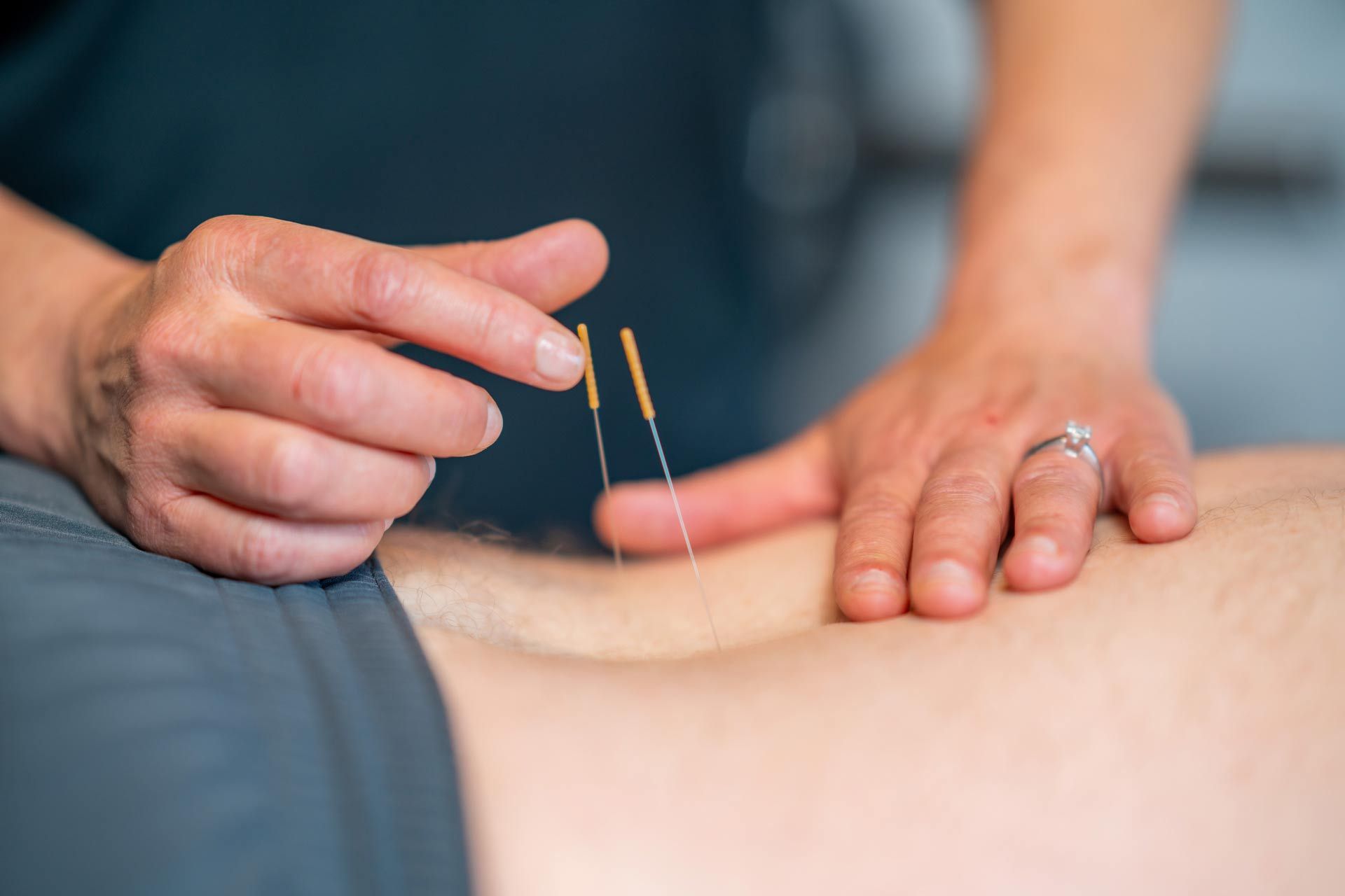A person is getting acupuncture on their back.