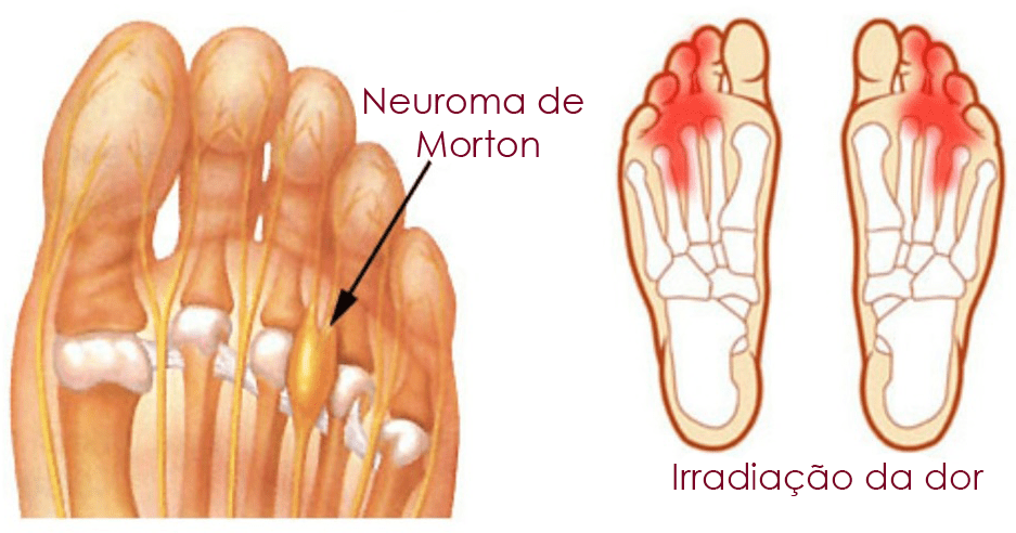 Neuroma-de-Morton