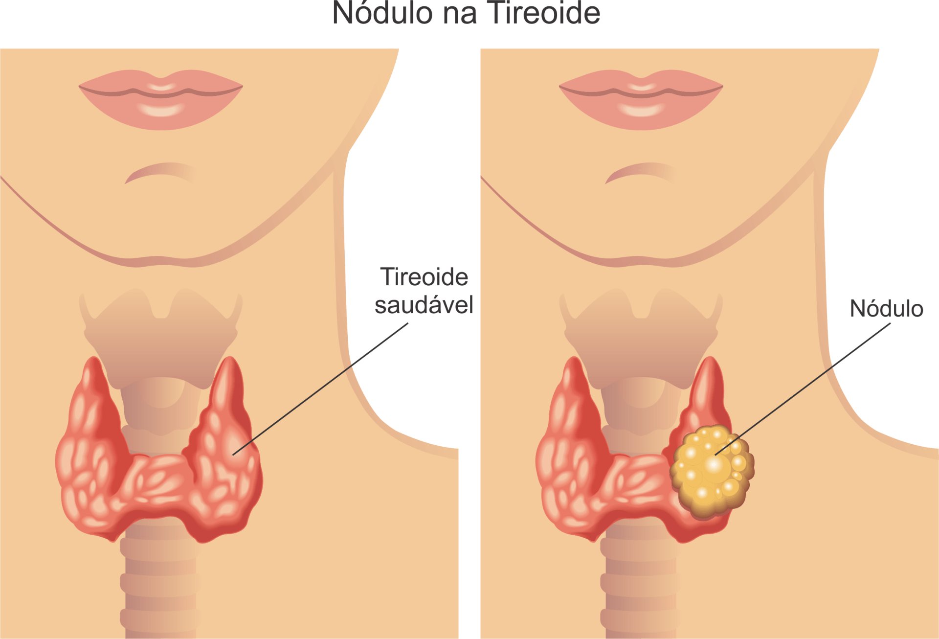 Do lado esquerdo uma tireoide saudável e do lado direito um nódulo na tireoide