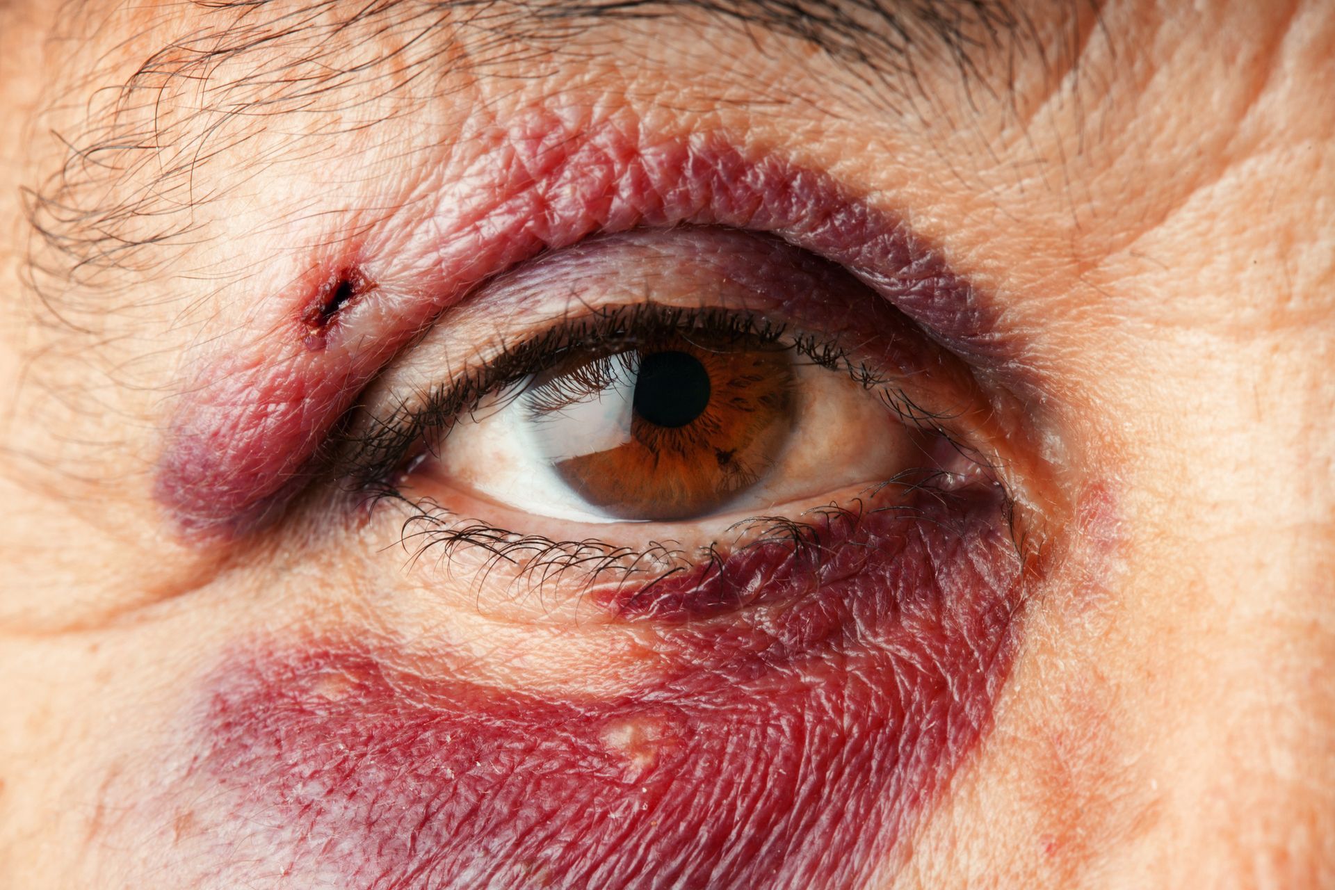 Close-up of an eye with a black eye and bruised skin. Brown iris, purple and red discoloration.