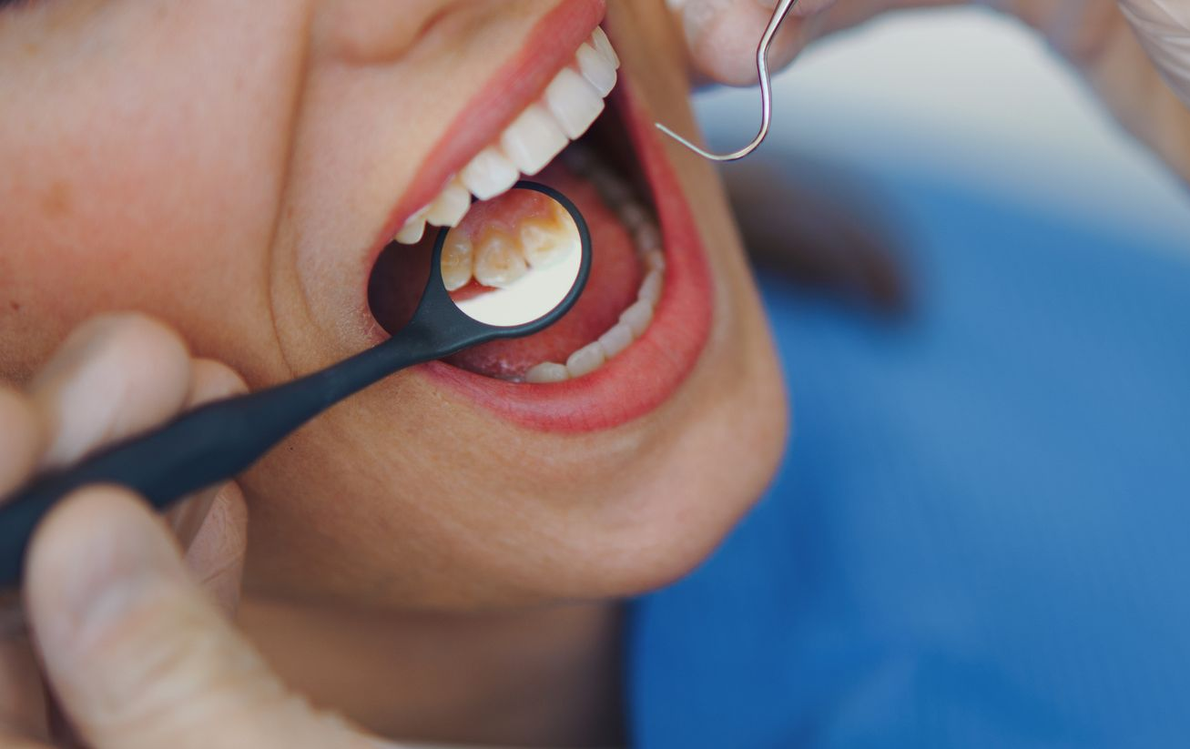 Dentista che esamina i denti di un paziente con uno specchio e strumenti odontoiatrici, primo piano.