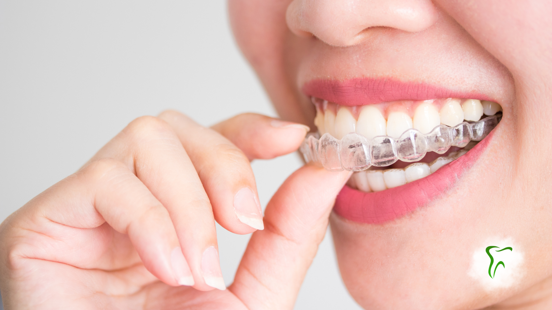 Woman inserting clear orthodontic aligner into mouth.