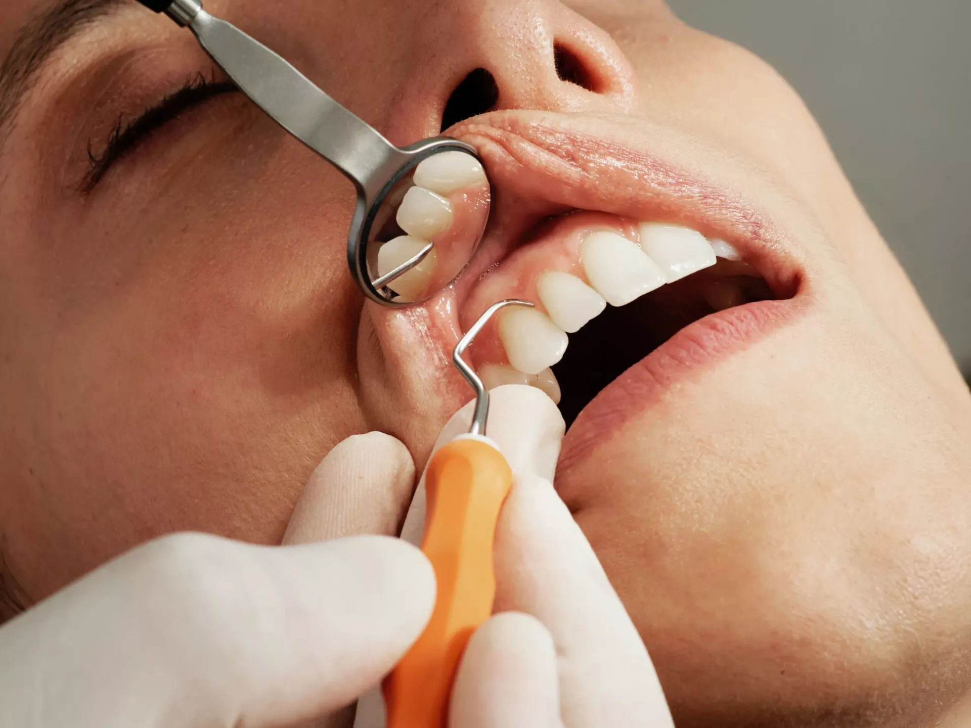 Patient getting their teeth cleaned to prevent cavities at SFD Patient getting their teeth cleaned to prevent cavities at SFD