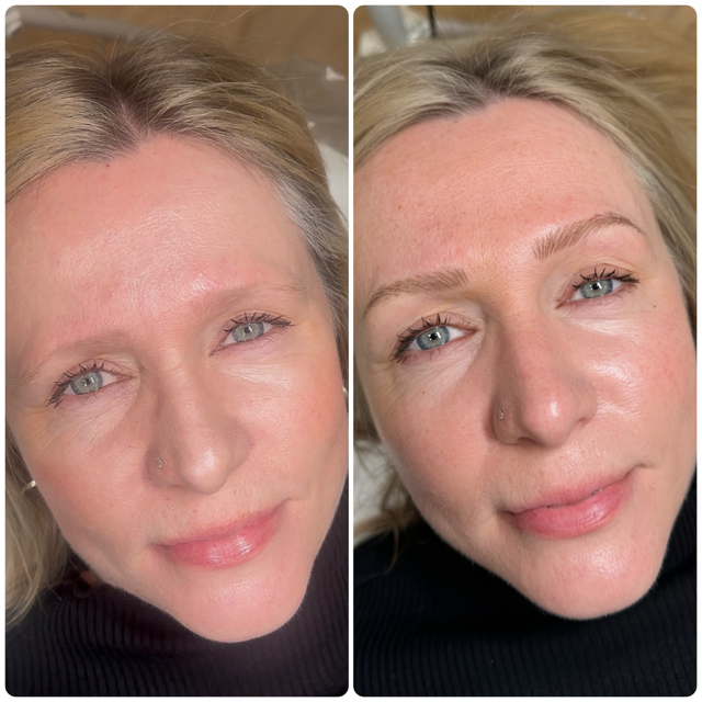 A before-and-after comparison of a person's eyebrows, showing the results of a cosmetic brow procedure.