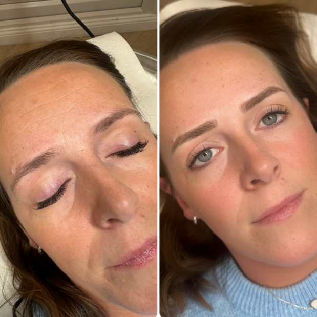 Before and after photos of a woman's eyebrows after a cosmetic procedure; eyebrows appear fuller and more defined in the after photo.