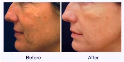 Pelleve Image-laser treatment in bowie, md