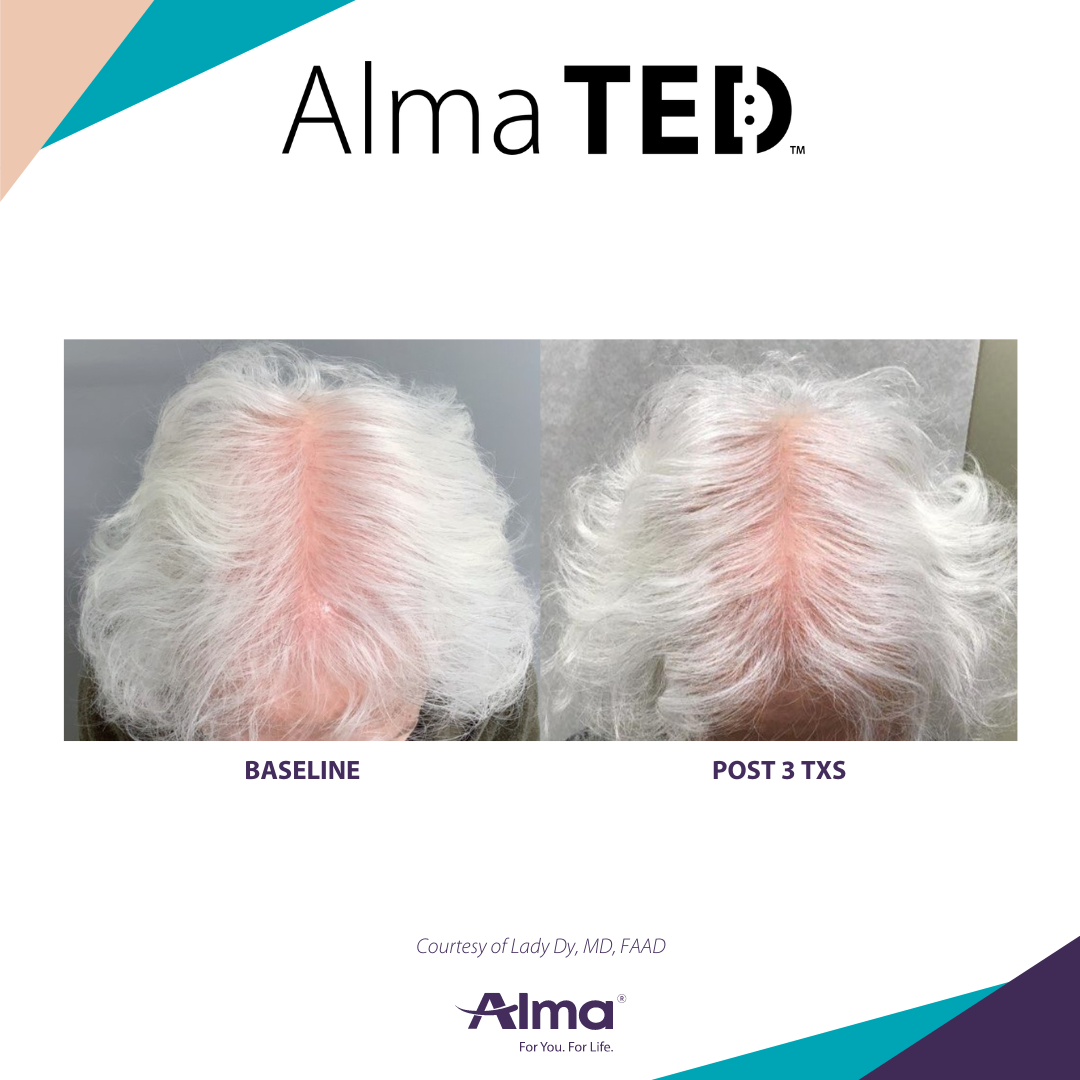 picture of a person's scalp before and after Alma Ted hair loss treatment