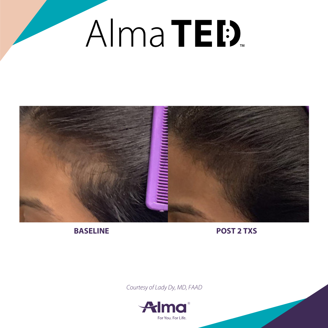 picture of a person's scalp before and after Alma Ted hair loss treatment