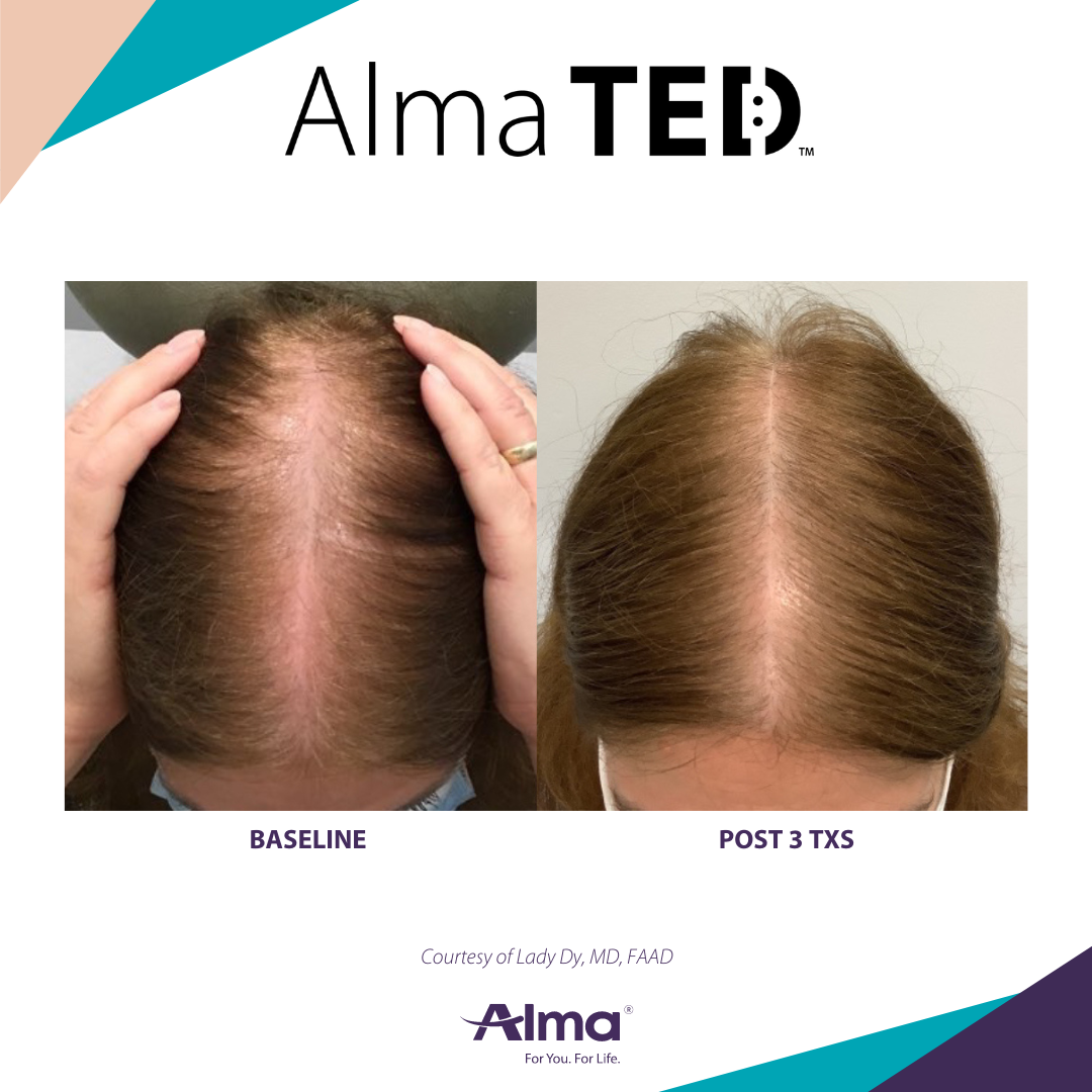 picture of a person's scalp before and after Alma Ted hair loss treatment