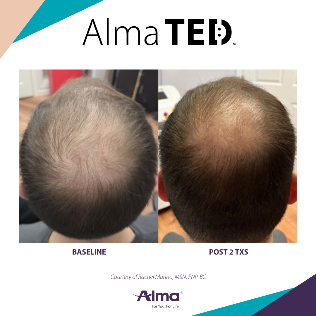 picture of a person's scalp before and after Alma Ted hair loss treatment