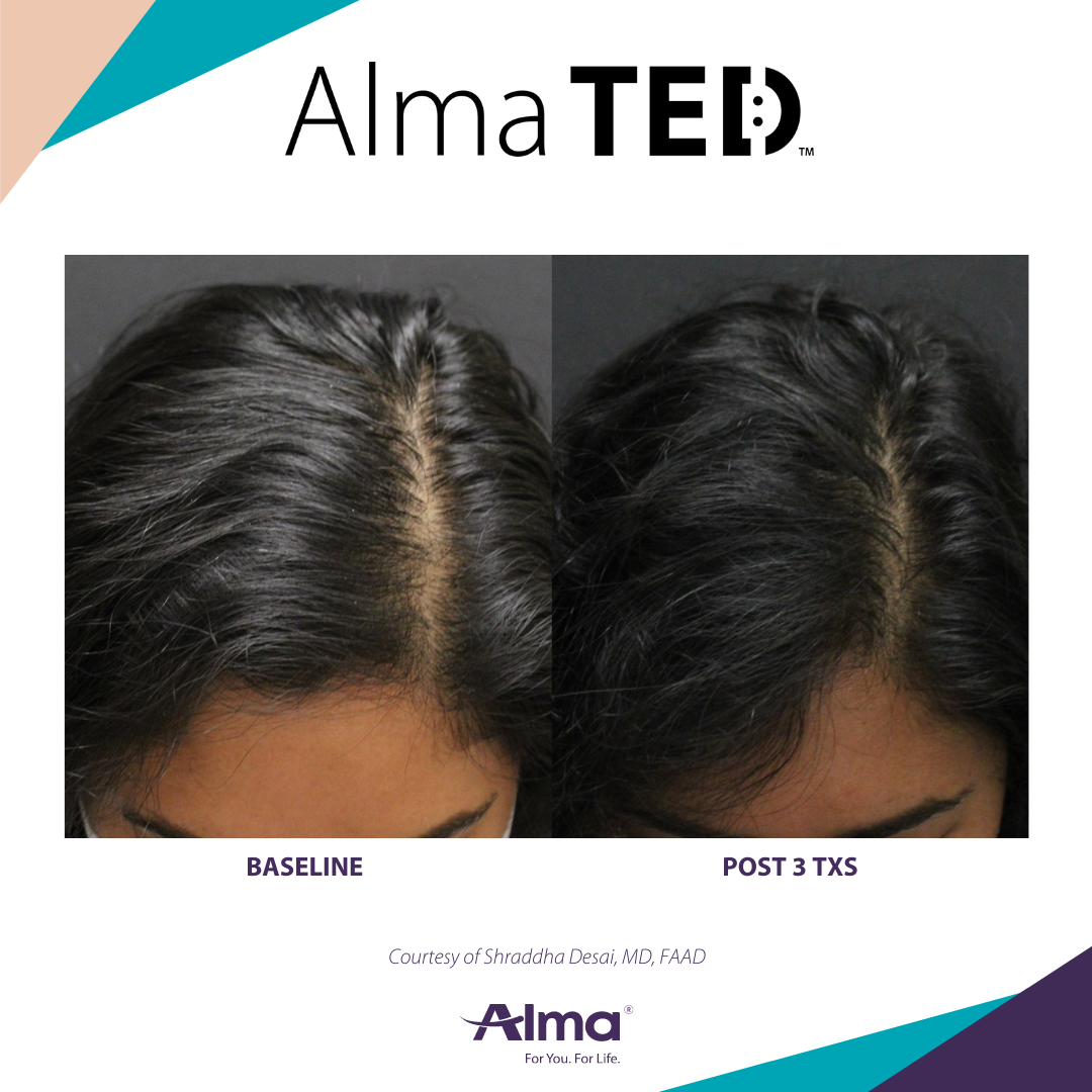 picture of a person's scalp before and after Alma Ted hair loss treatment