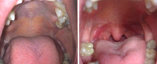 picture of a person's mouth before and after nightlase sleep apnea laser treatment