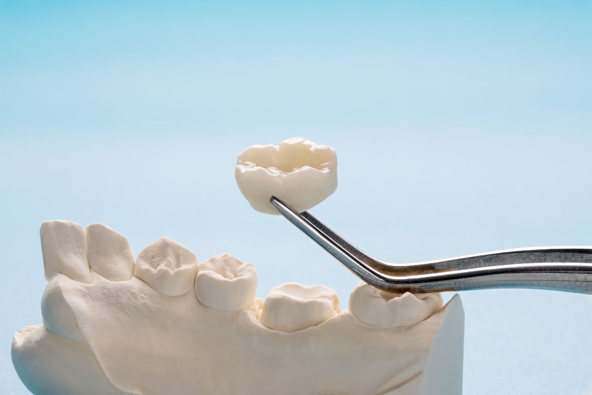 Dental crown held by tweezers above a plaster model of teeth