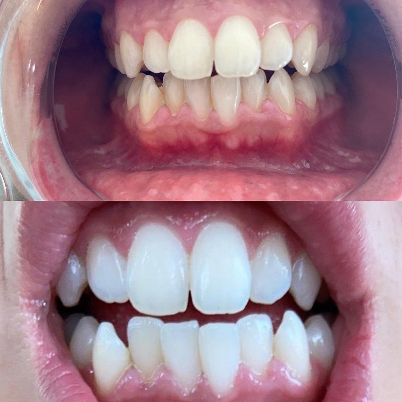 Teeth whitening before/after